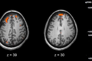 esquizofrenia-cerebro